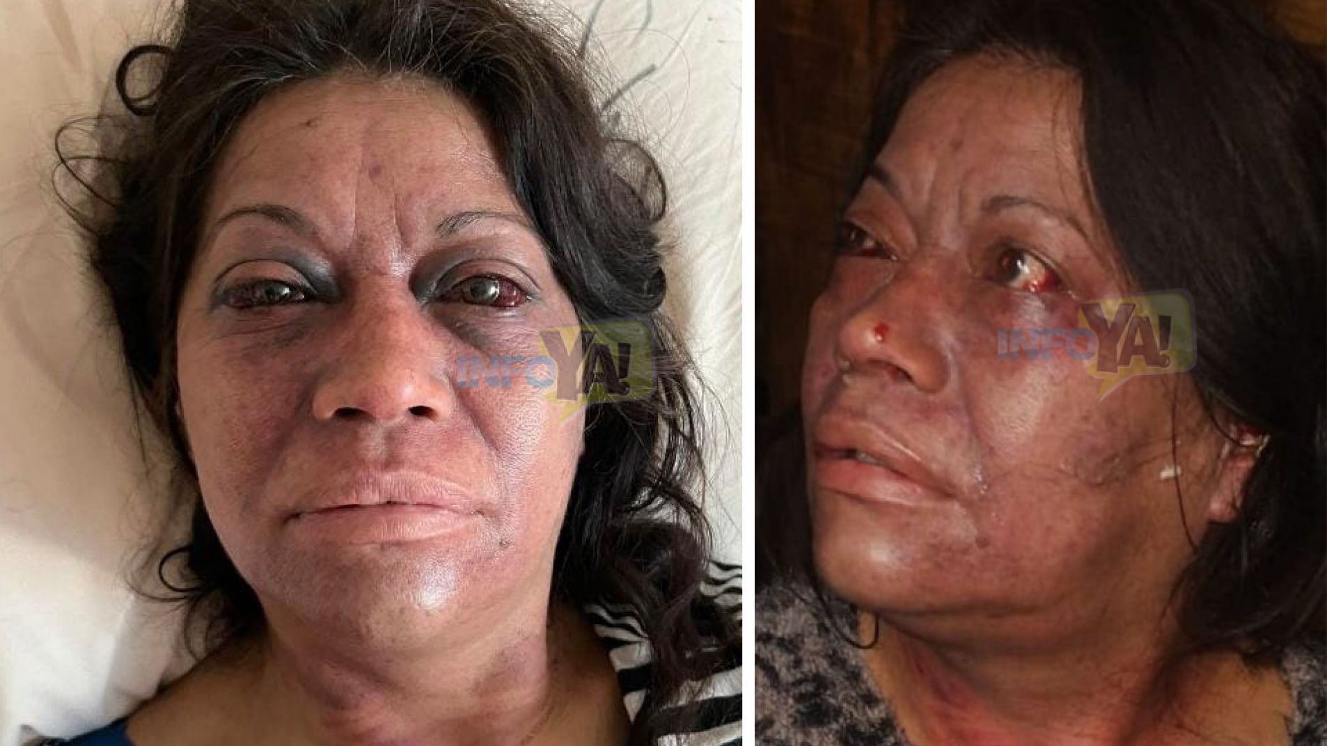 Así quedó la mujer que fue ahorcada y casi pierde la vida