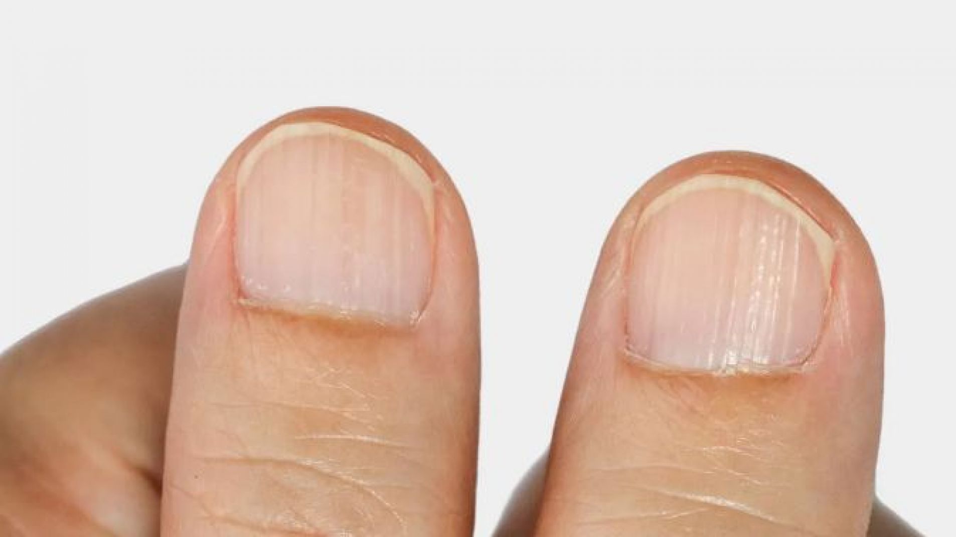 El motivo por el que podés tener las uñas rayadas
