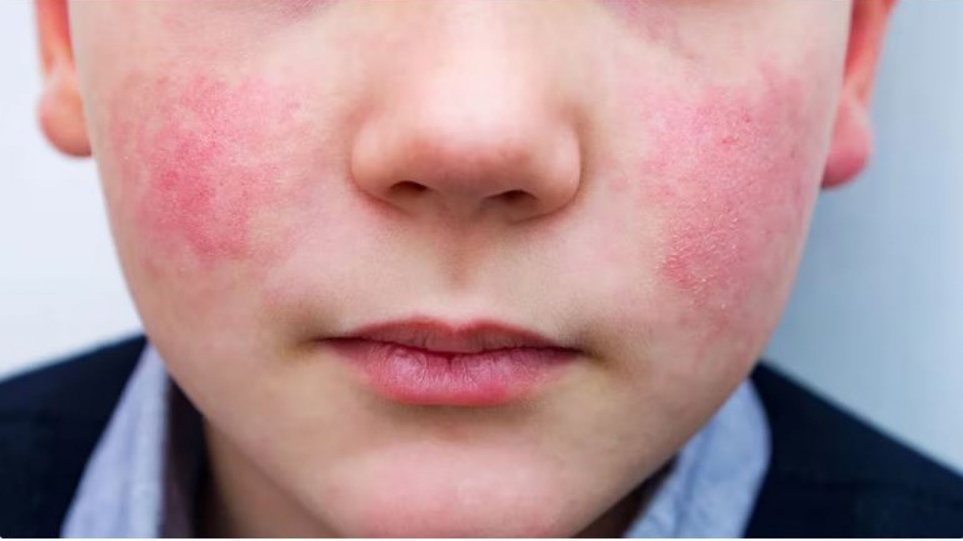 Crecen los casos en el mundo de la "quinta enfermedad"