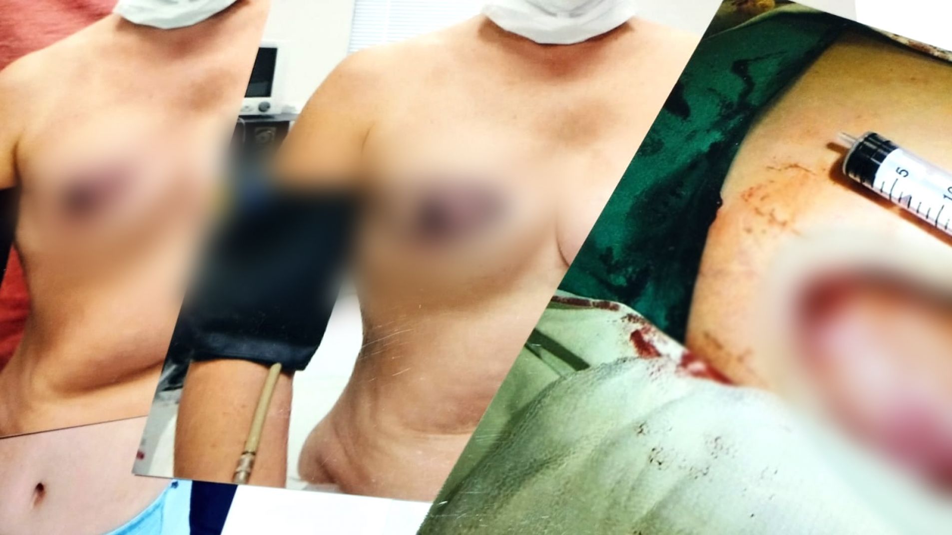 La Corte condenó a un cirujano plástico sanrafaelino por mala praxis