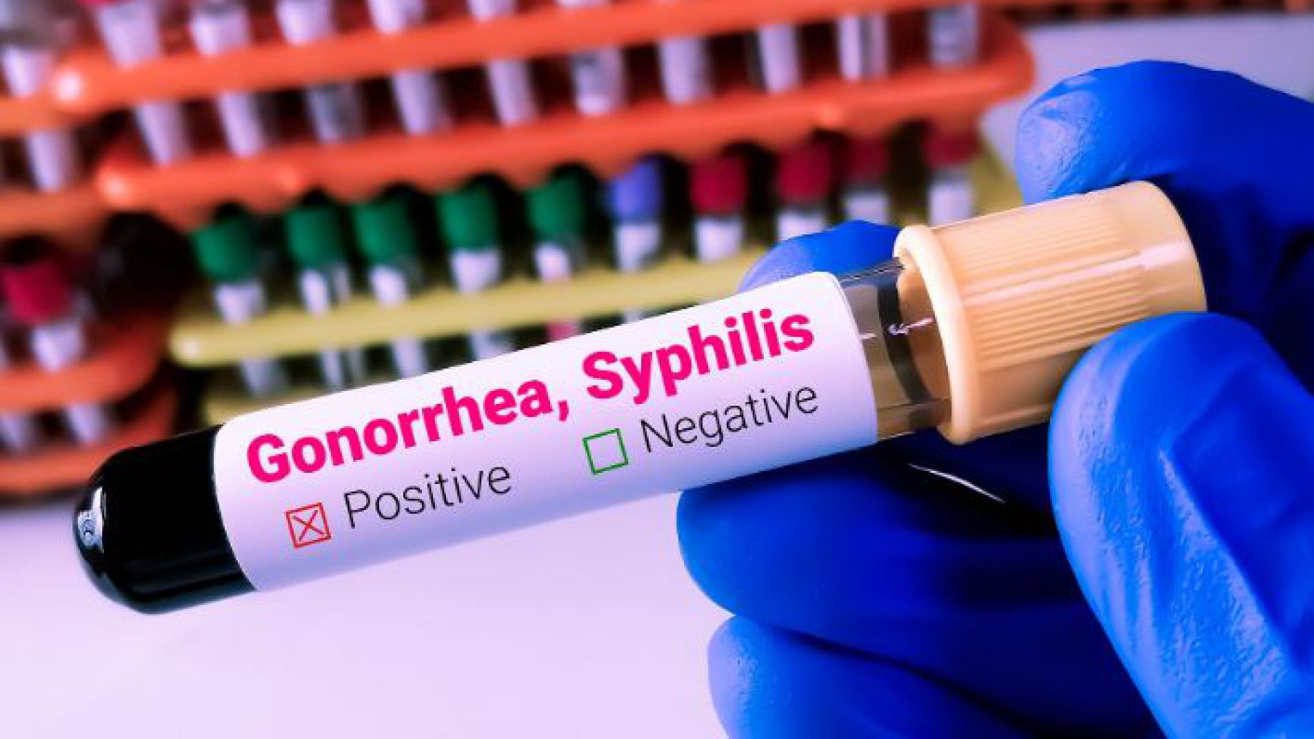 Sífilis: la infección de transmisión sexual de la que debes cuidarte