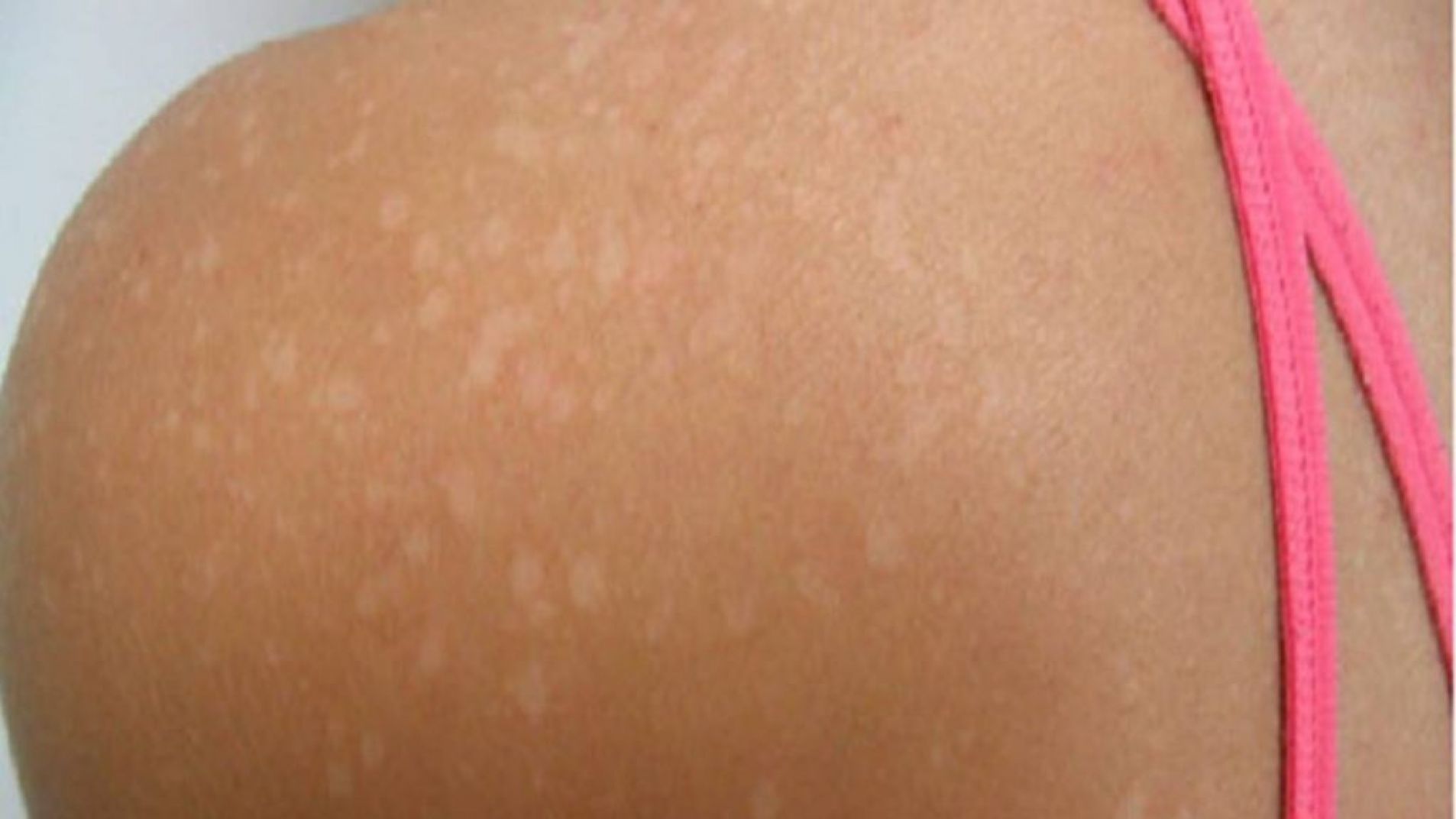 Manchitas blancas en la piel: por qué aparecen y cuáles deben tratarse