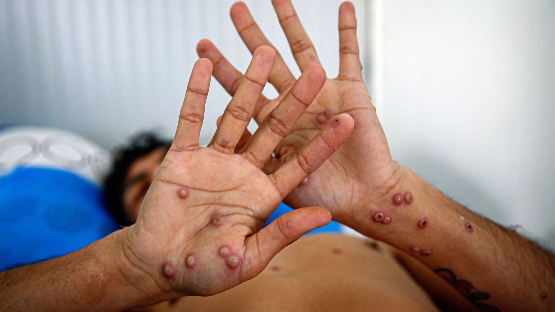 Confirmaron en Mendoza cinco casos de "viruela del mono" en una familia