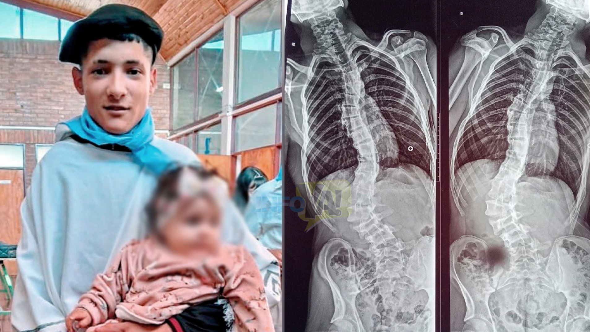 Presentaron una cautelar para que un joven se pueda operar de la columna