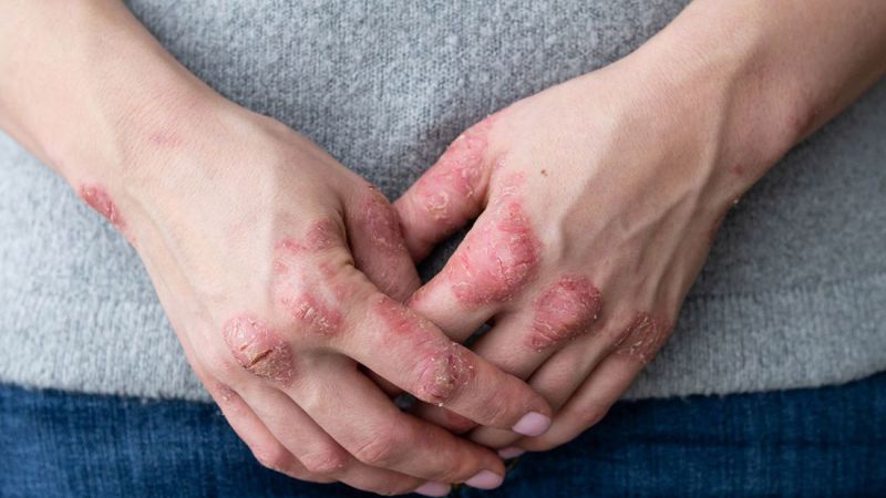 Bloque de reumatología: Qué es la artritis psoriásica, sus efectos y cómo se trata