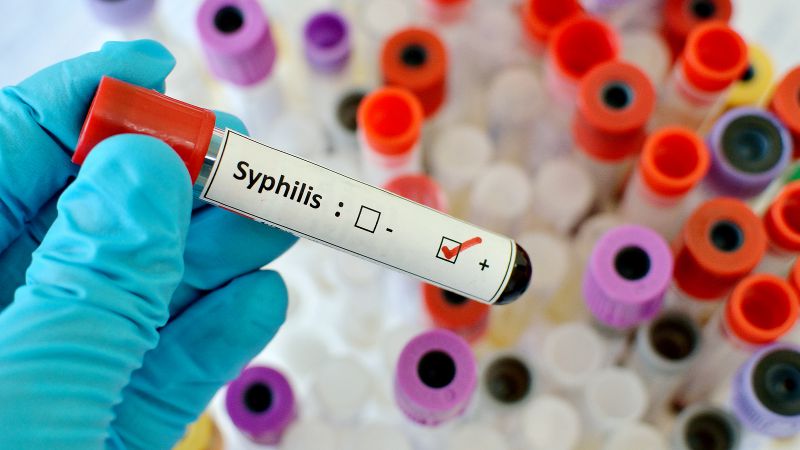 La sífilis avanza sin freno: el país enfrenta un brote silencioso record en América