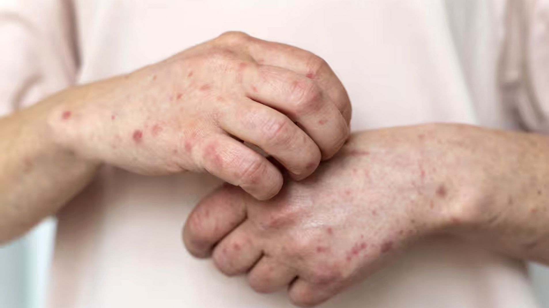 Activan alerta por el crecimiento de casos de sarampión: los síntomas