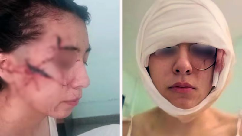 Intentaron degollarla: una adolescente fue desfigurada por cinco jóvenes