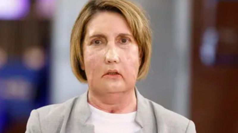 Una araña la desfiguró y una mujer que pidió la eutanasia le donó su rostro