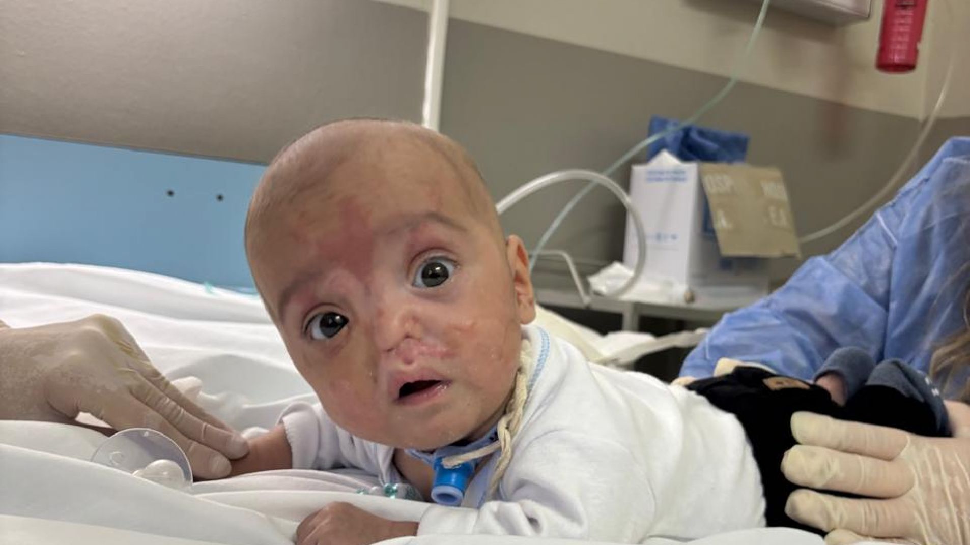 Piden oraciones por Benja, el bebé quemado tras una falla en su incubadora