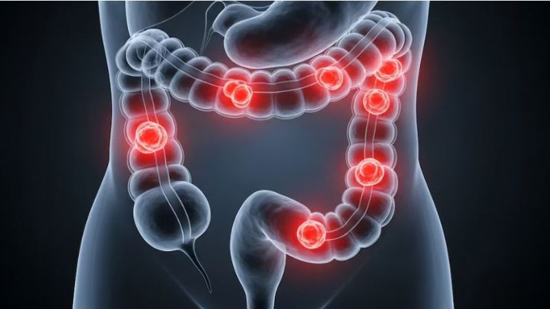 Cáncer de colon: la colonoscopía y el test FIT reducen los casos graves