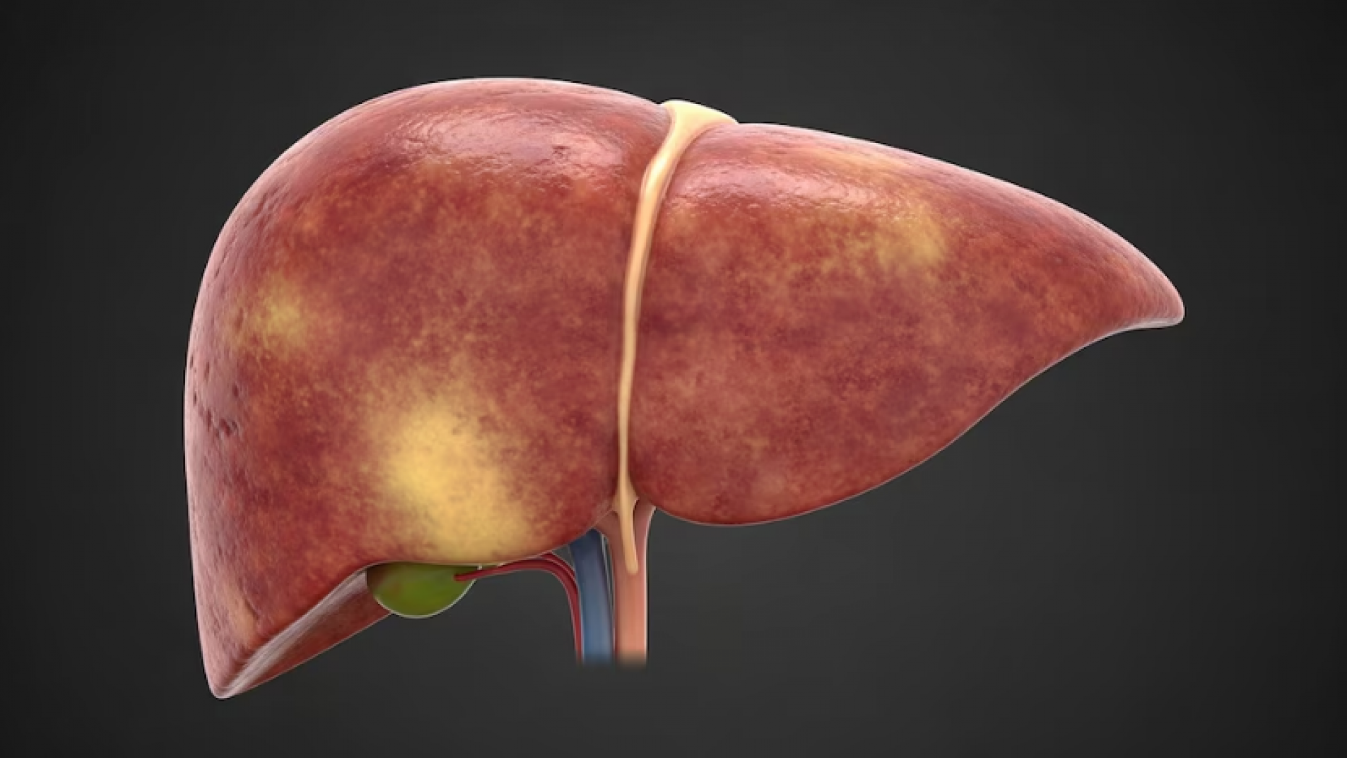 Hígado graso: cómo impacta el consumo de café en la fibrosis hepática