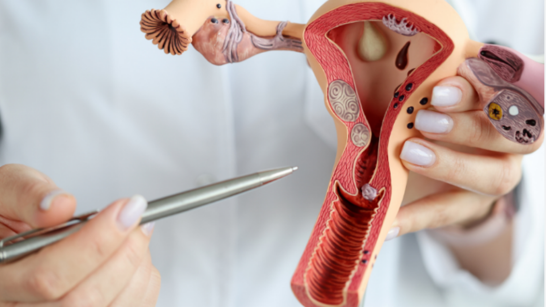 Día Mundial de la Endometriosis: no naturalizar el dolor es cuidar la fertilidad