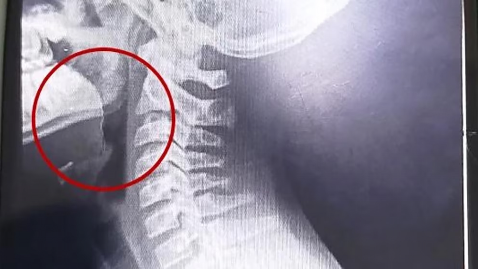 Comió una galletita y comenzó a escupir sangre: lo que hallaron los médicos